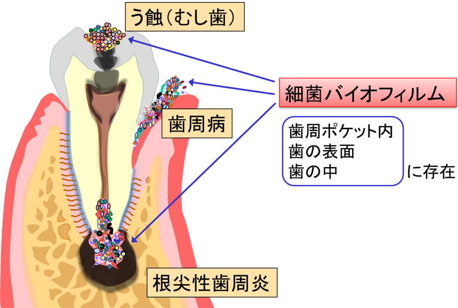 歯科の病気における最近バイオフィルムの形成