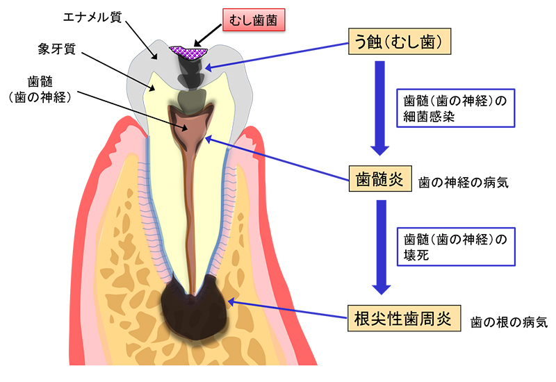う蝕（むし歯）の進行と歯の神経や根の病気の発症