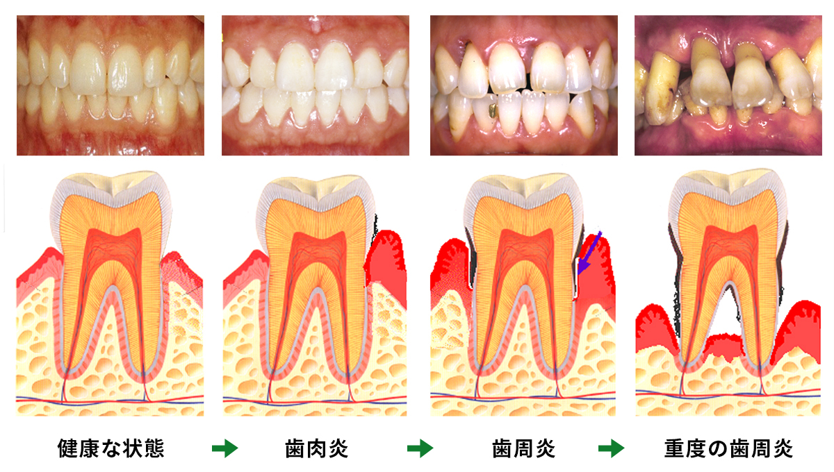 歯周病の進行