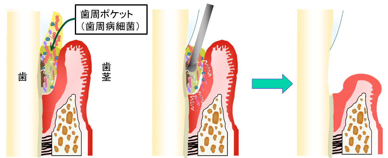 歯周治療（歯ぐきの治療）を受けられる患者さまへ