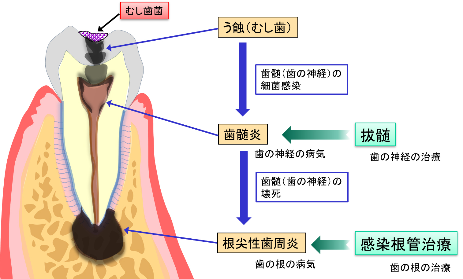 歯内治療（歯の神経や根の治療）とは